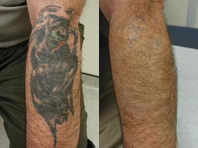 Laser Tattoo Removal