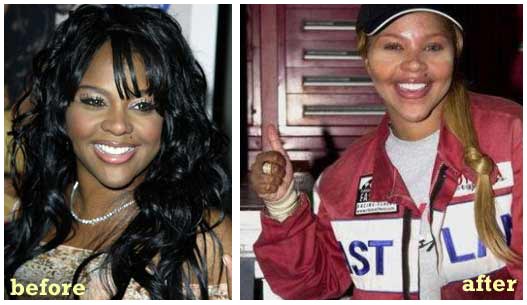 fergie plastic surgery before and after. Lil Kim Before And After