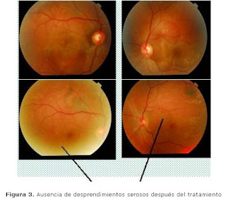 desprendimiento seroso de retina