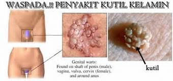 Obat Kutil Kelamin De Nature Depok