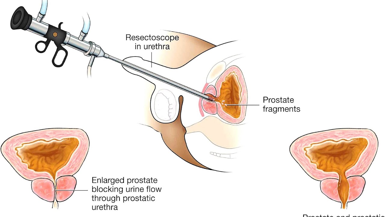 Urinary Catheter Alternatives