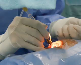 Epiretinal Membrane Surgery