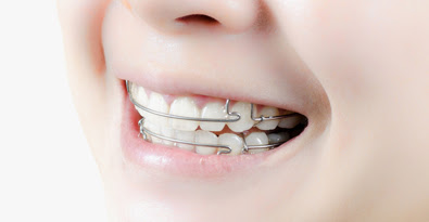 Tò mò niềng răng hàm dưới có đau không-2