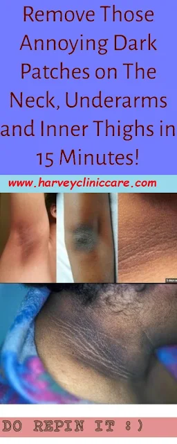 Remove Those Annoying Dark Patches On The Neck, Underarms And Inner Thighs In 15 Minutes