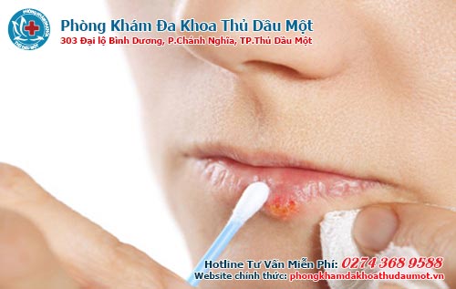 Thuốc bôi chữa mụn rộp sinh dục