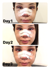 rhinoplasty nose eyelids epi epicanthoplasty zhongxiao dunhua zhongxiaodonglu