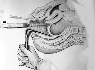   culdocentesis, culdocentesis positive result, culdocentesis definicion, culdocentesis non-clotting blood, culdocentesis procedure, culdocentesis procedure video, culdocentesis pronunciation, posterior colpotomy, angiography prep