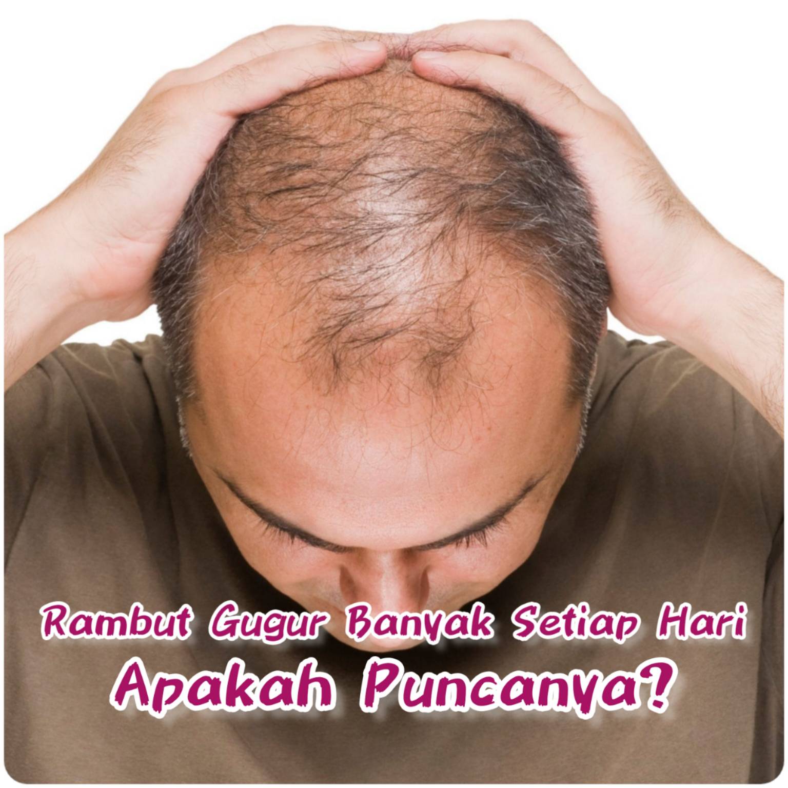 Rambut gugur, rawatan rambut gugur, jenis rambut gugur, punca rambut gugur, Hair PRP