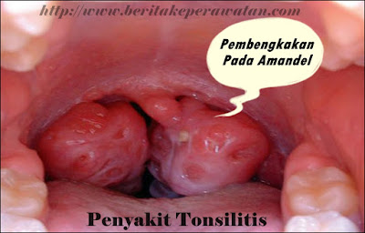 Penyebab Seseorang Mengalami Tonsillitis 