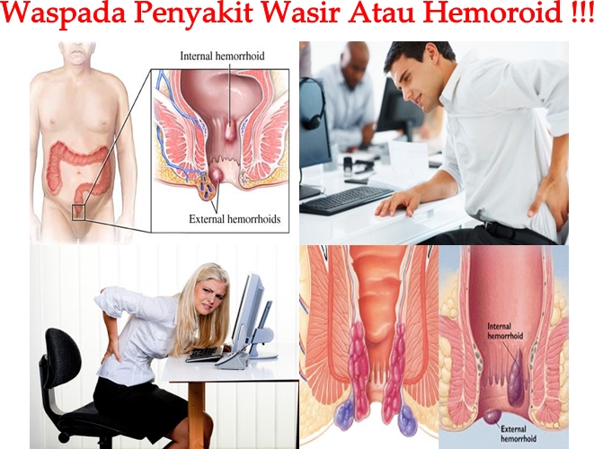 Obat Tradisional Wasir Atau Hemoroid