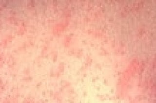 measles, measles rash, measles symptoms, measles vaccine, german measles, what is measles, what are measles, measles outbreak, measles in spanish, how long did it take to develop the measles vaccine, measles outbreak vancouver wa, measles treatments, measles deaths 2018, what does measles look like, measles mumps rubella, the measles, measles vaccine before 1989, measles death rate, measles deaths in us 2018, measles vaccine history, what do measles look like, washington measles, rubella rash vs measles rash, how do you get measles, ucla measles, how is measles spread, measles in adults, measles outbreak michigan 2019, clark county measles, portland measles, measles cruise ship, measles outbreak 2021, what causes measles, measles outbreak washington state, new york measles, how do you get the measles, when did the measles vaccine come out, measles contagious, measles treatment, measles vaccine side effects, measles mortality rate, how contagious is measles, measles symptoms in adults, fox news you measles, can you get measles after being vaccinated, measles rash pictures, measles virus, measles vaccine effectiveness, measles precautions, measles airborne, deaths from measles in us, measles definition, is measles deadly, cdc measles deaths, measles rockland county, measles transmission, how many people die from measles, measles outbreak deaths, roseola vs measles rash, measles death rate before vaccine, measles mumps rubella vaccine, chicken pox measles, measles r0, measles meaning, precautions for measles, if you had measles as a child are you now immune, when was the measles vaccine created, measles vaccine age, costa rica measles, r0 of measles, when was measles vaccine invented, german measles vs measles, symptoms of measles, measles pictures, measles brooklyn, what is the measles, is measles airborne, measles disease, measles vs chicken pox, measles vaccine name, measles en español, measles vs rubella, measles titer, rubeola measles, can you get measles twice, koplik spots measles, can you get the measles if you've been vaccinated, measles vaccine efficacy, how long does measles last, rubella vs measles, measles shot, cdc measles outbreak 2018, how effective is the measles vaccine, measles deaths in us 2017, when do you get the measles vaccine, measles complications, measles 中文, how does measles spread, texas measles, measles survival rate,