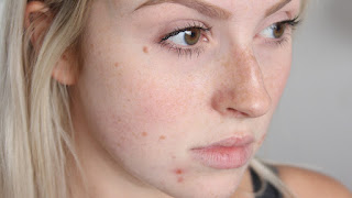 Original Image with pimples and sun spots