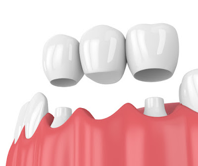 Làm cầu răng là gì và áp dụng khi nào?