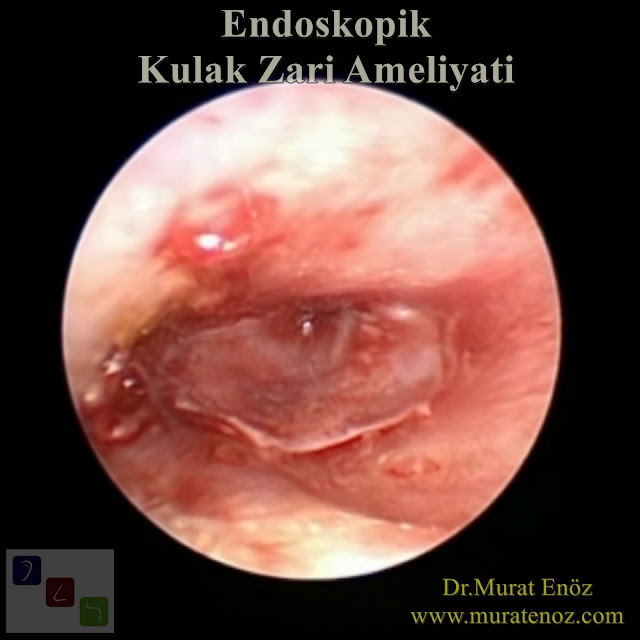 Endoskopik Kulak Zarı Ameliyatı - Endoskopik Miringoplasti - Endoskopik Kulak Zarı Tamiri - Endoskopik Miringoplasti - Transkanal Endoskopik Miringoplasti - Endoskopik Kulak Zarı Operasyonu - Transcanal Endoscopic Myringoplasty - Endoscope Assisted Myringoplasty, Endoscopic Myringoplasty - Endoscopic-Assisted Myringoplasty - Endoscopic Eardrum Hole Surgery - Endoscopic Repair of Tympanic Membrane Perforation