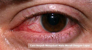 Cara Ampuh Mengobati Mata Merah Dengan Cepat, mengobati sakit mata, penyebab sakit mata