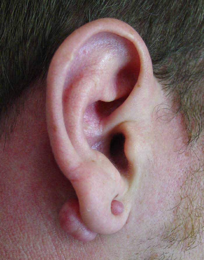 Doctors Gates: Keloids of the Auricle