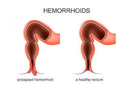 Hemorrhoids treatment in singapore