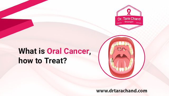 What is Oral Cancer