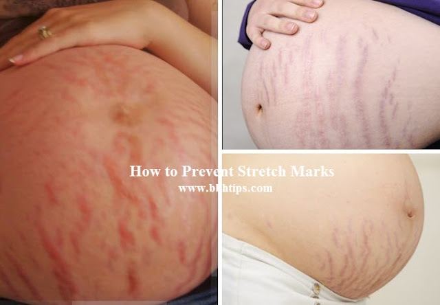 How Prevent Stretch Marks