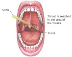 How To Know If I Have Throat Cancer - Throat Cancer S Link To Oral Sex What You Should Know Cleveland Clinic / In each case it is important to know exactly what type of cancer has developed, how large it has become, and cancer of the larynx is sometimes called laryngeal cancer.
