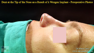 Breathe Implant à Wengen,4. revision nose job, Dent After Rhinoplasty, Complicated 4th Revision Rhinoplasty, Nasal contour irregularities, Postoperative dent issues, Revision rhinoplasty challenges, Rhinoplasty side effects, Nasal structural integrity,