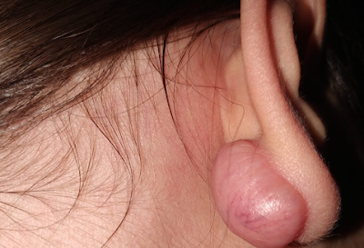 Ear Keloid Removal