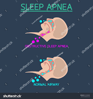 Research on sleep apnea in children