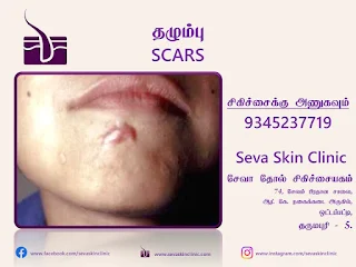 scar treatment