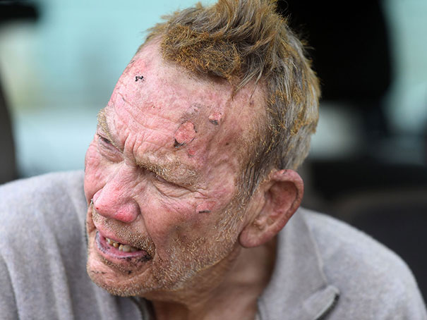 This man burned his face in the process of rescuing dogs from his burning animal shelter.