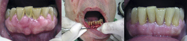 <Img src ="Cirugía-periodontal-remodelación-hueso-y-encía.jpg" width = "893" height "196" border = "0" alt = "Tratamiento quirúrgico de encía y hueso".>