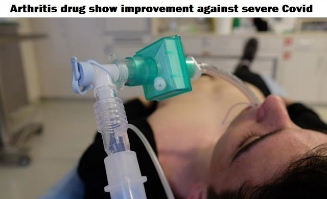 Arthritis drug show improvement against severe Covid: study