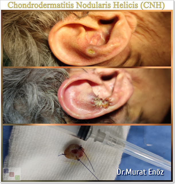 Chondrodermatitis Nodularis Helicis, CNH, Auricle lesion, Small tender nodule on the auricle