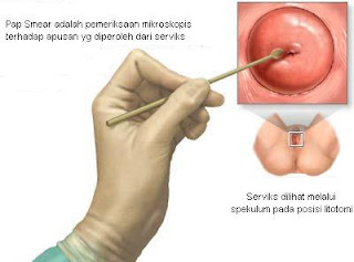  yaitu tumor ganas yang tumbuh di dalam leher rahim Kanker Leher Rahim, serang perempuan usia 35-55 tahun