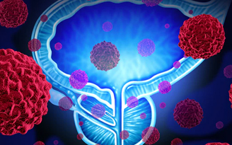 What is prostatic hyperplasia-PSA that is associated with prostate cancer? - What do you want to study?