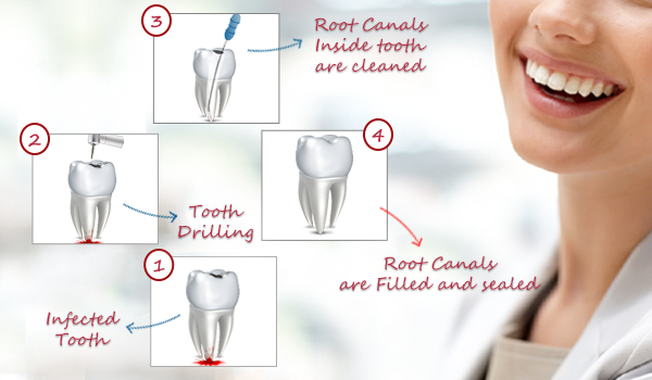 Root Canal Treatment In Gurgaon