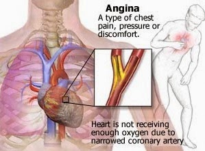 Angin Duduk atau Angine Pectoris