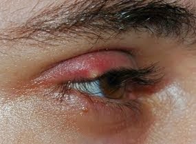 Penyakit mata blefaritis 