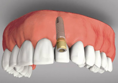 cost tooth implant