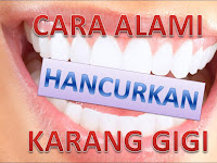 Cara Menghilangkan Karang Gigi Yang Sudah Mengeras