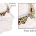 How To Relieve Your Sinus Infection In Few Seconds
