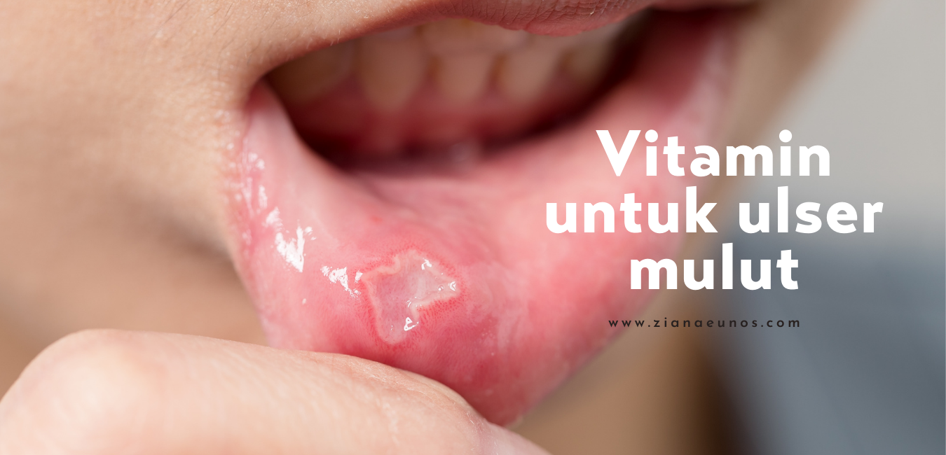 vitamin untuk ulser mulut