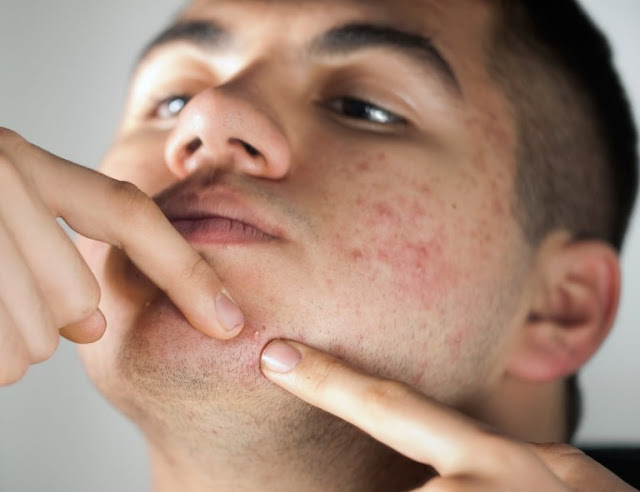 9 Habits that cause Acne