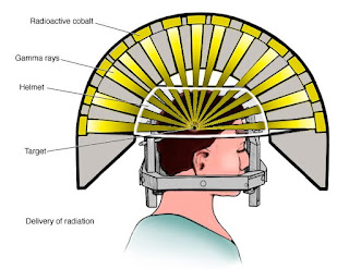 Stereotactic Radiotherapy 