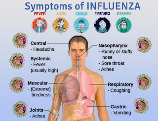 Infeksi Virus Influenza