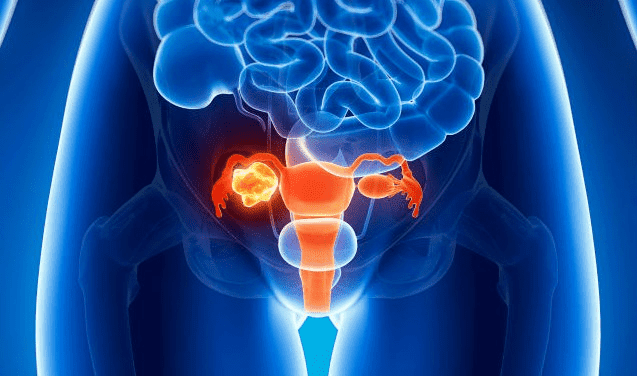 ovarian-cancer-symptoms-and-treatment