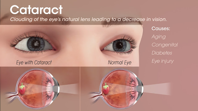 Eye Screening Experience At My Vision Eye Specialists at LifeCare Diagnostic Medical Centre In Bangsar South Kuala Lumpur
