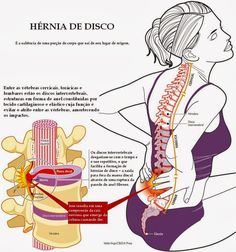 Ozonoterapia Madrid Tratamiento De La Hernia Discal Con