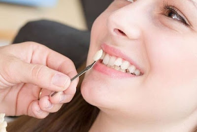 Bọc mão sứ cho răng khểnh có tốt không? 