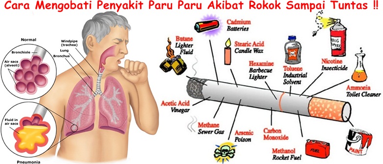 Obat Herbal Paru Paru Akibat Rokok