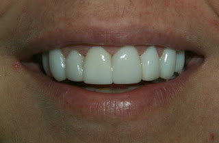 lumineers teeth